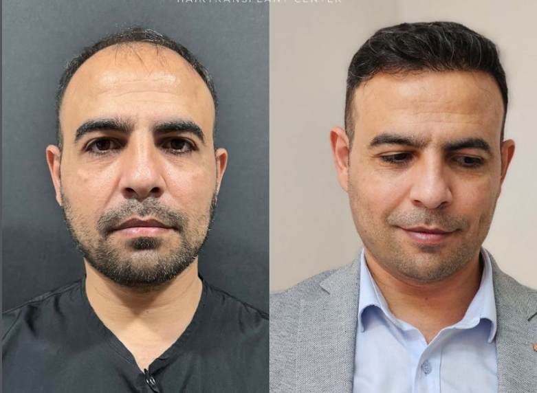 Saç ekimi öncesi sonrası 11 - MicroFUE 3200 greft