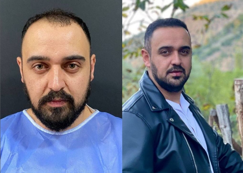 Saç ekimi öncesi sonrası 12 - Traşsız 2800 greft