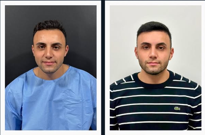 Saç ekimi öncesi sonrası 2 - MicroFUE 3000 greft