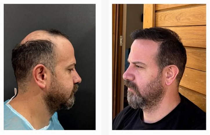 Saç ekimi öncesi sonrası 6 - MicroFUE 2800 greft