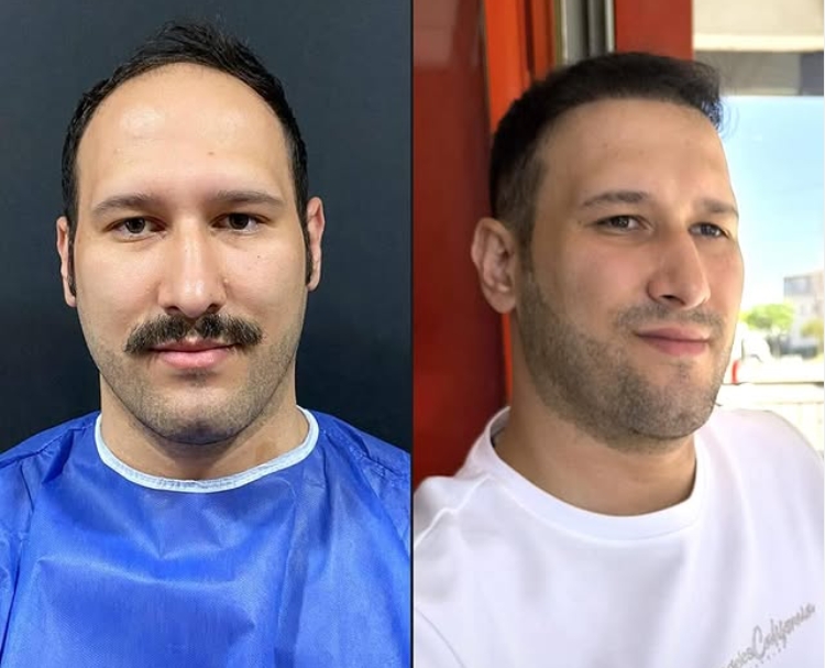 Saç ekimi öncesi sonrası 8 - Traşsız 3000 greft