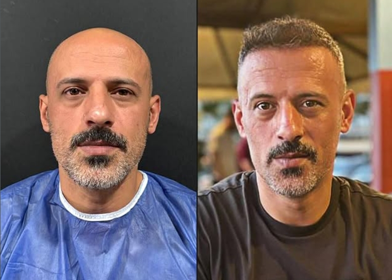 Saç ekimi öncesi sonrası 9 - MicroFUE 4500 greft